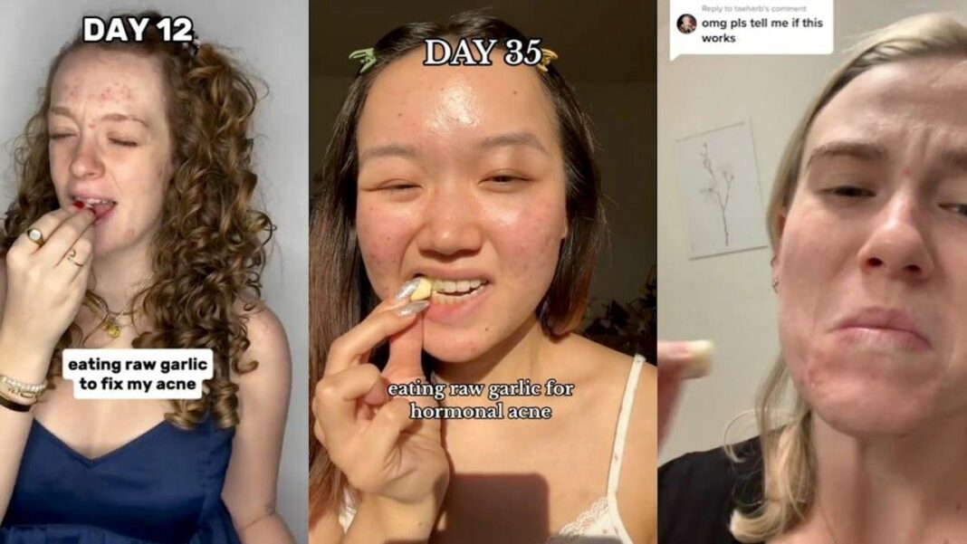 source:scarymommy - Aglio per l'Acne: Rischi e Verità da Conoscere